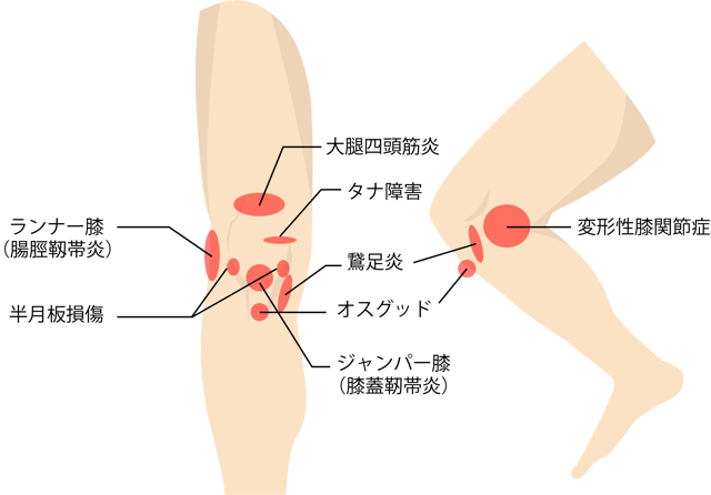 膝が痛い,膝の痛み,種類,場所,症状