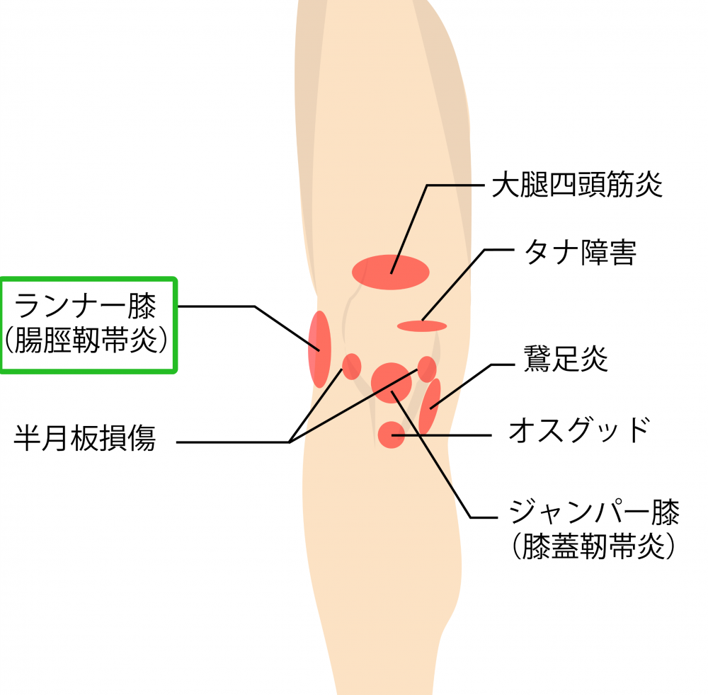 ランナー膝,腸脛靭帯炎,膝が痛い,膝の痛み,種類,場所,症状