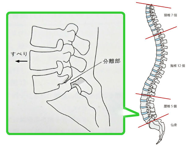 腰椎変性すべり症,腰痛,お尻全体の痛み,太ももの裏の痛み,足にしびれ