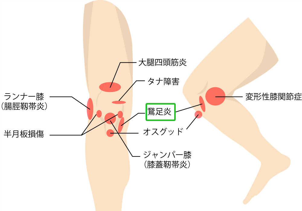 鵞足炎